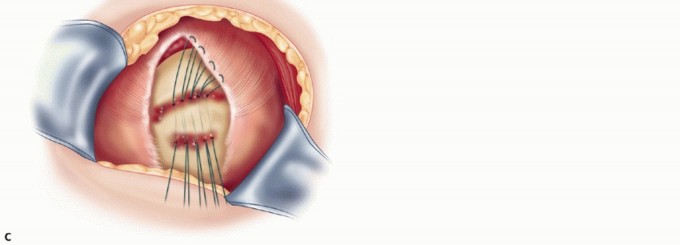 Illustration 16 for Subscapularis & Teres Rotator Cuff Repair: Advanced Techniques