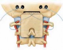 Illustration 11 for Cervical Fusion: The Line is Drawn for Lasting Stability