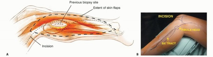 Illustration 6 for Beyond Amputation: The Type I Resection in Fibular Tumor Surgery