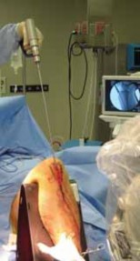 Illustration 46 for Optimal Nailing of the Tibia: Techniques for Challenging Fractures