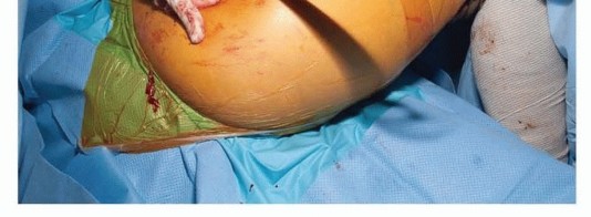 Illustration 12 for Surgical Hip Dislocation Safety: The Branch of the MFCA's Vital Role