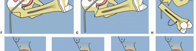 Illustration 25 for Treatment for Congenital Femoral Deficiency: What You Need to Know