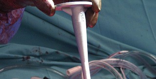 Illustration 33 for Hinged Total Knee: The Salvage Solution for Challenging Cases