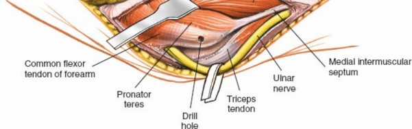 Illustration 36 for Mastering Elbow Approaches: Applied Surgical Anatomy for Precision