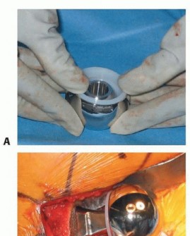 Illustration 40 for Hemiarthroplasty of the Hip: Indications & Types Explained