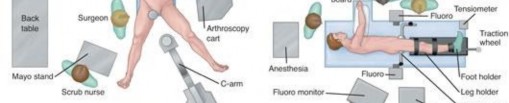 Illustration 151 for Understanding Hip Arthroscopy: The Basics Explained