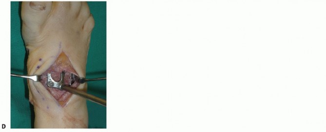 Illustration 54 for Mastering Midfoot Arthrodesis: Protect the Deep Neurovascular Bundle