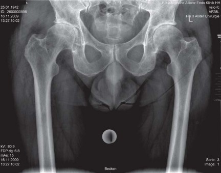 Illustration 8 for Collum Femoris Preserving: Achieve Better Primary Hip Outcomes