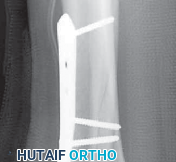 Illustration 50 for Optimizing ORIF for Tibial Plafond Fractures: A Modern Approach