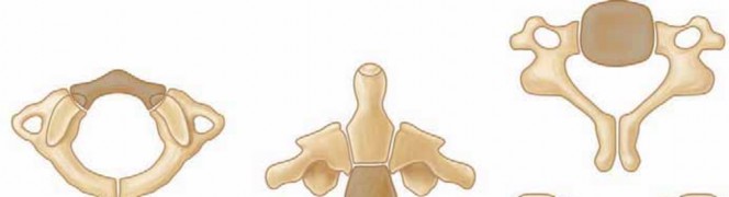 Illustration 2 for Cervical Fusion: The Line is Drawn for Lasting Stability