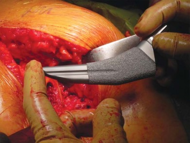 Illustration 45 for Unlock better THA: The technique of short stem for less invasiveness