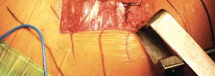 Illustration 11 for Metal on Metal Resurfacing: Enhanced Posterior Soft Tissue Repair