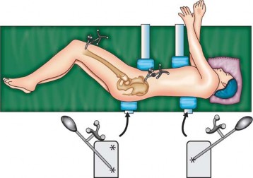 Illustration 8 for Avoiding Errors: Navigation in Total Hip Arthroplasty