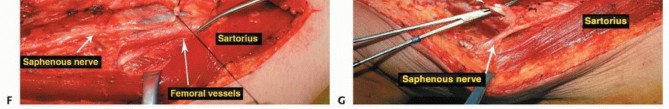 Illustration 31 for Advanced Distal Femoral Resections: Limb-Sparing Outcomes & Techniques