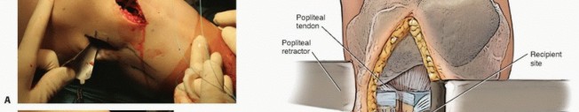 Illustration 17 for Symptomatic Knee? Meniscal Transplant for Anterior & Posterior Horns