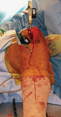 Illustration 24 for Optimize Tibial Component Alignment: Techniques for TKA Success