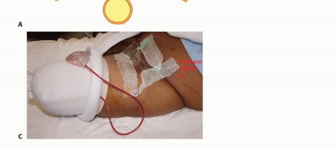 Illustration 19 for Mastering Above-Knee Amputation: Essential Surgical Insights