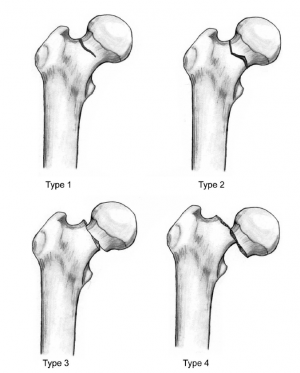 Femur Neck Fracture: Uncover Symptoms & Best Treatment