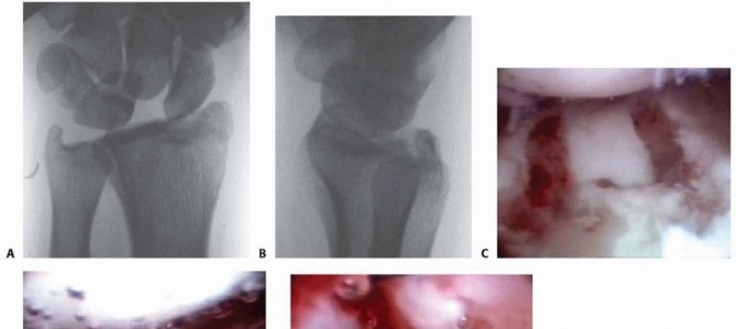 Illustration 8 for Arthroscopic Fixation: Effectively Treating Radial Styloid Fragments