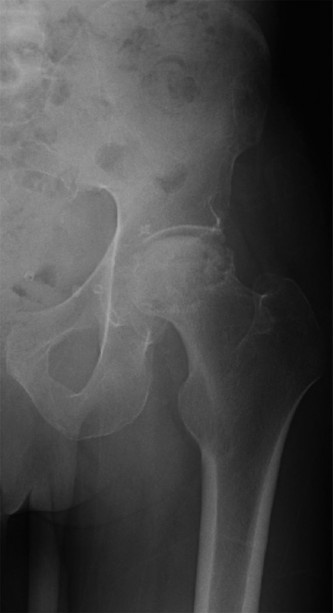 Illustration of reconstruction cases avascular - Dr. Mohammed Hutaif