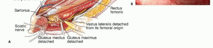 Illustration 22 for Beyond Amputation: Total Femur Resection with Endoprosthetics
