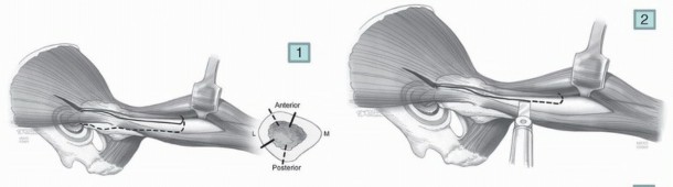 Illustration 9 for Mastering Component Removal: Extended Trochanteric Osteotomy