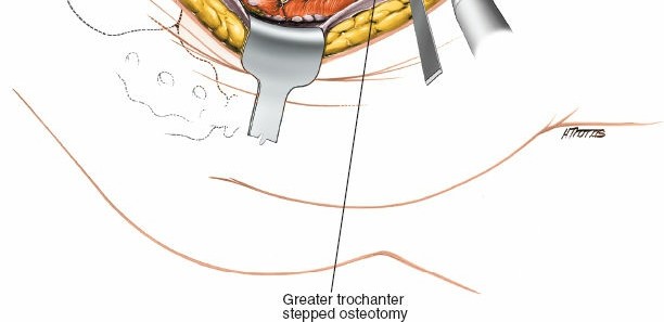 Illustration 15 for Acetabulum Posterior Approach: Simplest Fix for Hip Fractures