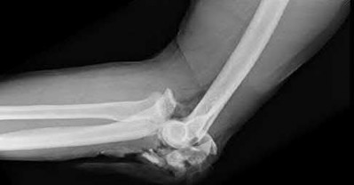 Illustration 117 for OrthoCash: Trauma MCQs & Cases for a yearold woman