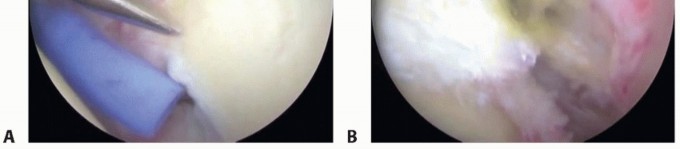 Illustration 13 for Decompressing the Transverse Scapular Ligament for Shoulder Pain Relief
