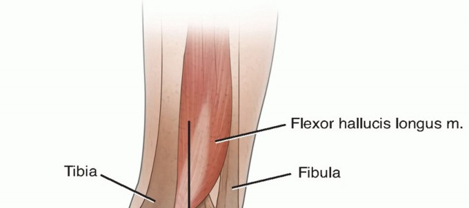 The Talus Microfracture Perspective: Is it Truly Effective?