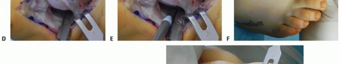 Distal Chevron Osteotomy: Mastering Lateral Soft Tissue Release