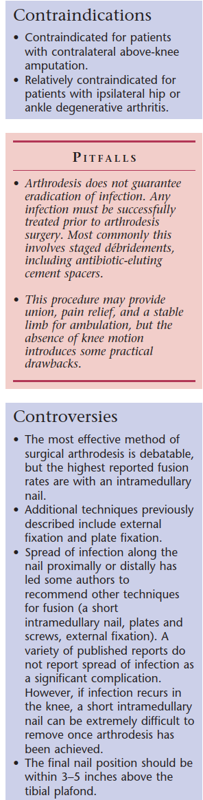 Illustration of total knee arthroplasty - Dr. Mohammed Hutaif