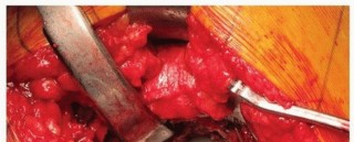 Illustration 15 for Uncemented Acetabular Revision: Optimizing Hemispherical Cup Use