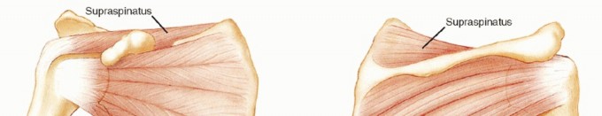 Bankart Repair & Inferior Capsular Shift: Solving Shoulder Instability