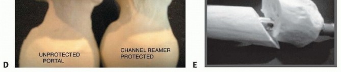 Illustration 21 for Achieve Optimal Femoral Head Fixation with Cephalomedullary Nailing