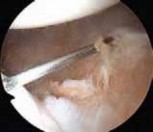 Illustration 31 for Regain Stability: Anterior Shoulder Instability Arthroscopic Fix