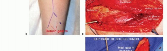 Illustration 7 for Soleus Resection for Tumors: Protecting the Heads of the Gastrocnemius