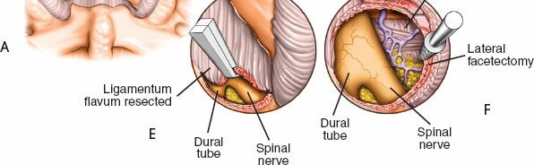 Illustration 33 for Approach to the Lumbar Spine: Mastering Techniques & Anatomy