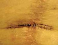 Illustration 9 for Knee Arthrodesis: A Lifelong Knee Solution for Trauma & TKA