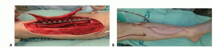Illustration 43 for Free Vascularized Fibular Grafts: Solving Complex Bone Defects