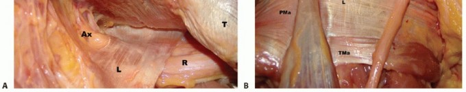 Illustration 2 for Restore Shoulder Function with Latissimus Dorsi Tendon Transfer