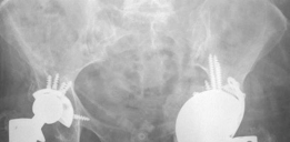 Illustration 6 for Mastering Severe Bone Loss: Highly Porous Metal for Revision THA