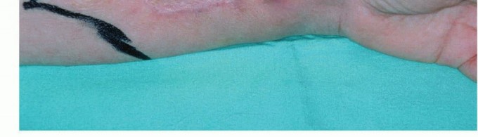 Illustration 11 for Above-Elbow & Below-Elbow Amputations: When & Why They're Needed