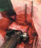 Illustration 19 for Increased Femoral Anteversion: A Proximal Femoral Rotational Osteotomy