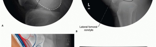 Illustration 4 for Repairing Distal Femur Fractures: Open Reduction & Internal Fixation