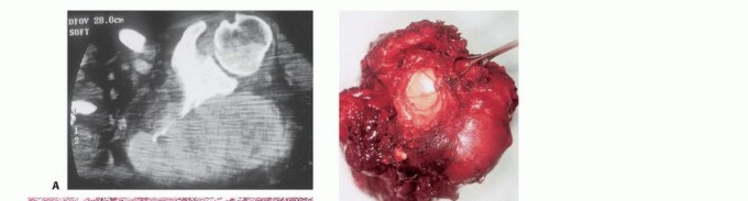 Illustration 51 for Understanding Benign Bone Tumors: Your Complete Preoperative Guide