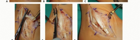 Repair of Peroneal Tendon: Understanding & Healing Your Tears