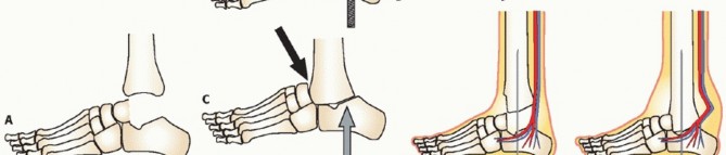 Illustration 11 for Beyond Amputation: Circular Fixation for Infection of the Talus