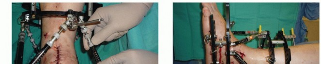 Illustration 49 for Optimize Pain Management with Proximal Ring Block for Ankle Arthrodesis