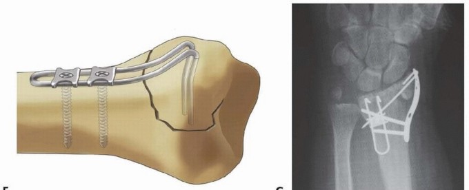 Illustration 28 for Fragment-Specific Fixation: Restore Carpal Facet Horizon